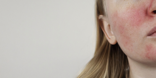 Peau sensible : comprendre pour mieux protéger